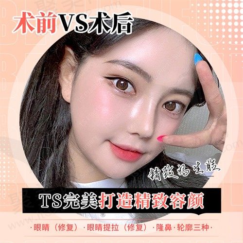 韩国TS眼睛修复+隆鼻+轮廓整形，为求美者呈现精致五官且饱满的脸型！