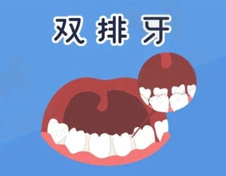 小孩为什么会长双排牙图片？儿童双排牙什么时候拔较好？