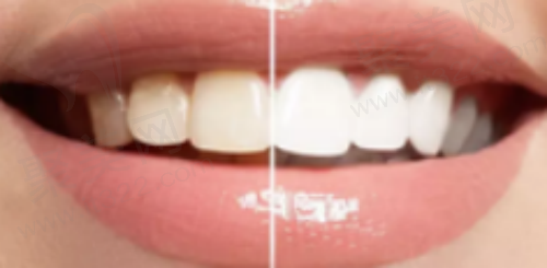 激光美白牙齿和冷光美白哪个好？对比优缺点和价格就知道了！