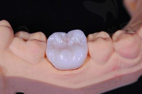 二氧化锆全瓷牙多少钱一颗？二氧化锆全瓷牙和普通全瓷牙的区别在哪？