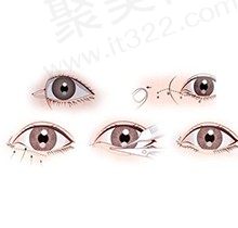 北京师丽丽眼做双眼皮价格多少？修复复杂的双眼皮费用、眼综合都有