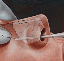 深圳李信峰在哪个医院？做鼻子贵吗？探到鼻综合4万起/修复7万起