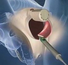 变性手术男变女还能生孩子吗？好奇能过夫妻生活吗？后期激素需要多少钱