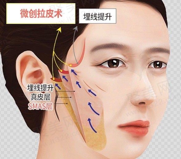 全脸拉皮除皱需要多少钱？公布全脸拉皮除皱手术费用一览表！