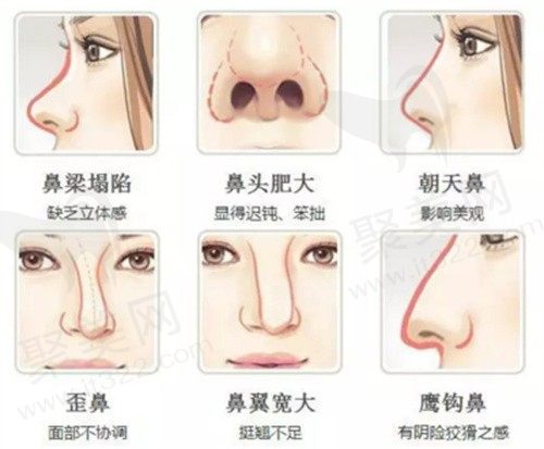 做完玻尿酸隆鼻可以再做肋骨鼻吗？玻尿酸隆鼻几天就不高了正常吗