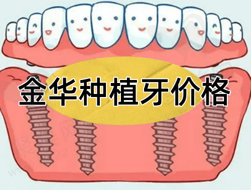 金华种一颗牙多少钱？来看2023金华集采后种植牙价格是多少？