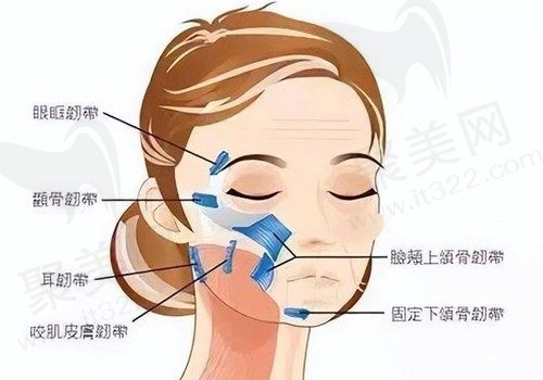筋膜悬吊术可以去除法令纹吗？眼部皱纹行吗？其价格又在多少？