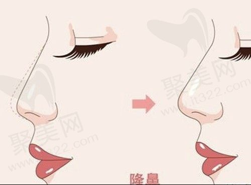 做肋骨鼻可以管一辈子吗？自从用肋软骨垫鼻基底后悔了！