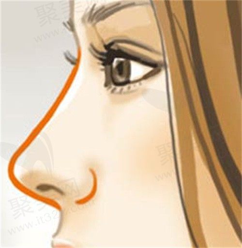 膨体隆鼻可以只修复鼻头吗？做膨体隆鼻8年了可以取出来吗？