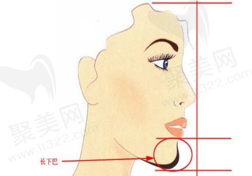 下巴太长怎么自然变短？几指宽才算正常，下巴缩短术价格又是多少？