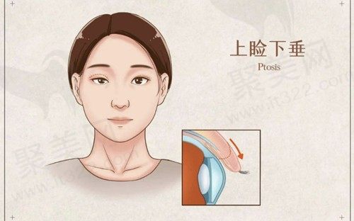 上眼睑下垂可以矫正吗？一探眼部整形手术的解决方案及手术费用