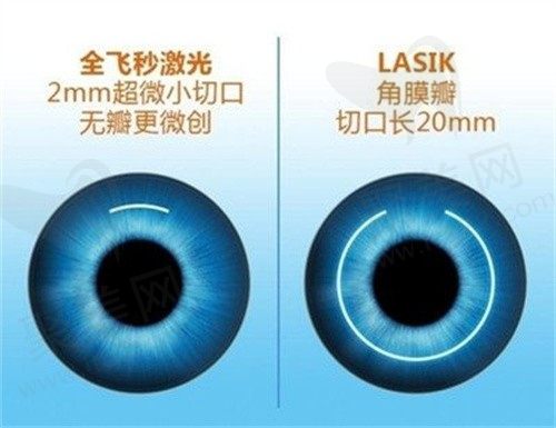 现在的近视手术成熟吗？想知道做近视眼手术大概需要多少钱？