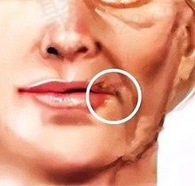 2023拉皮手术价格一览表，含北京|上海|广州等地拉皮技术好的医生及费用