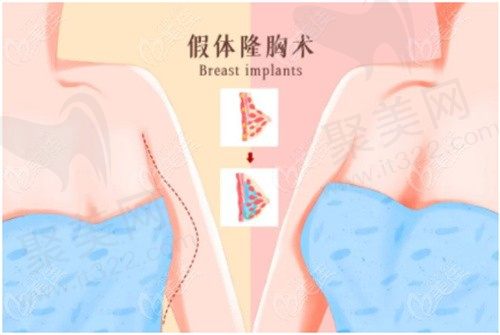 唐山煤医郭万厚假体丰胸怎么样？触感柔软自然是平胸妹的福音