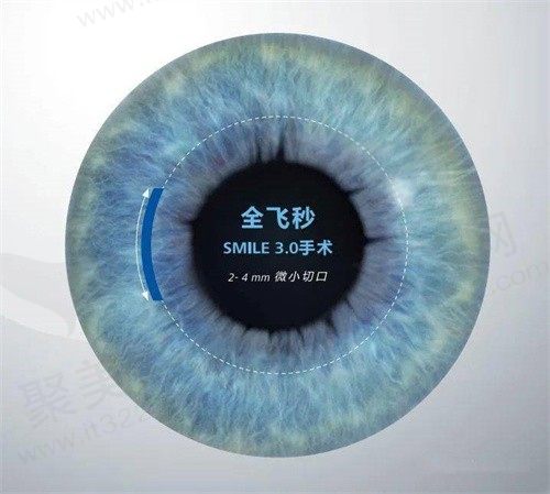 上海普瑞眼科全飞秒价格是多少？蔡司全飞秒双眼15800元起