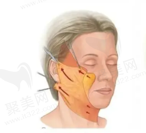 面部大拉皮手术大概需要多少钱？想知道拉皮手术多大年龄做合适？
