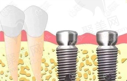 上海迈维口腔种植牙价格让人心动：韩系种植牙5K起每颗好划算
