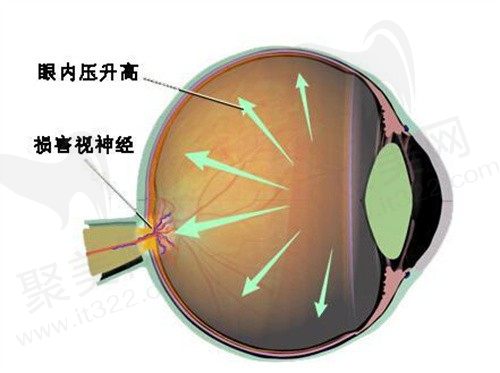 青光眼的7大征兆是什么？想知道得了青光眼做手术需要多少钱？