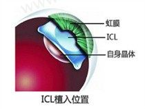 晶体icl植入
