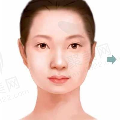 下巴假体能带一辈子吗?使用十年想取出可以吗?取出时会碰到哪些危险！
