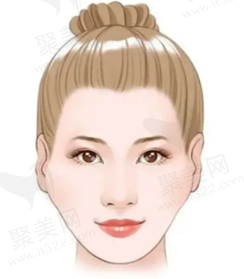 颧骨内推手术恢复期多久？颧骨内推加下颌角截骨大概要多少钱？