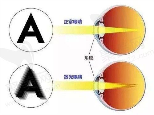 眼睛近视加斜视怎么治疗？成人斜视和近视手术一般多少钱？