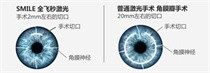 全激光手术
