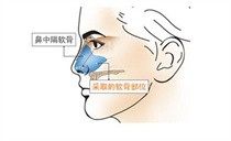 鼻综合