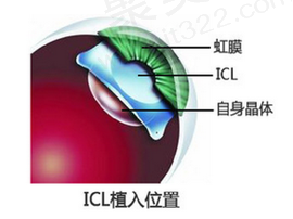 郑州尖峰眼科近视手术费用多少？晶体植入2.9w起12家分院通用