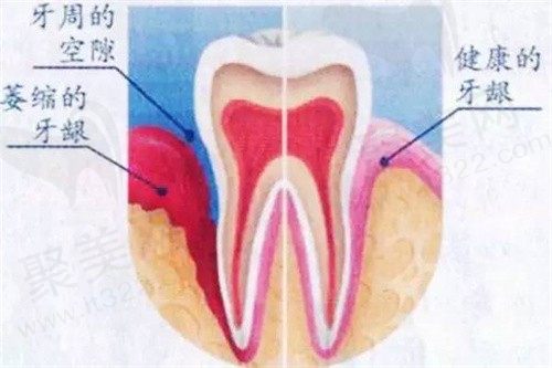 求问牙龈翻瓣手术痛苦吗？想知道做完翻瓣术后牙龈能恢复吗？