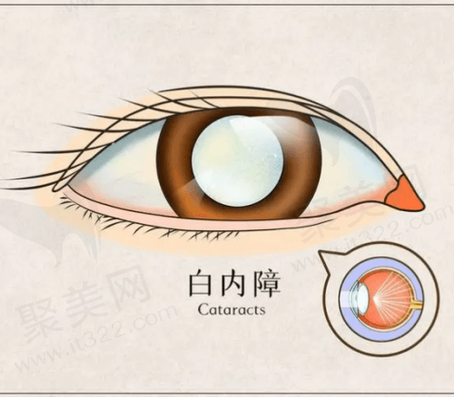 白内障的症状和表现是什么？白内障手术要多少钱？术后多久能恢复？