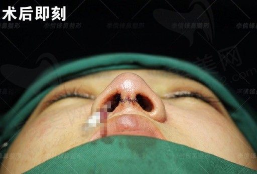 深圳李信锋做鼻子技术怎么样?看求美者鼻修复后的评价好吗?