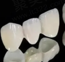 门牙为什么不建议做全瓷牙？全瓷牙使用寿命短价格还贵！