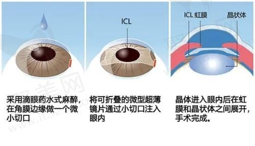 ICL晶体植入手术多少钱？ICL晶体植入手术会不会痛有没有风险?ICL晶体可以在眼内保持多久？