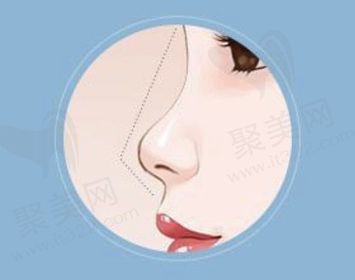 杭州薇琳隆鼻就找温科磊，做出来的样子好看还不贵