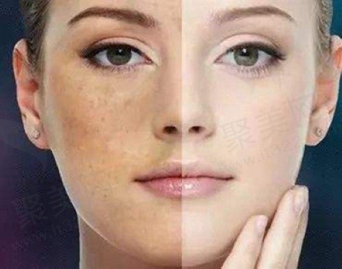 光子嫩肤做几次才能有用？如果光子嫩肤停了会反弹吗？