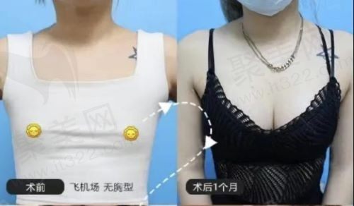 给各位刘亦菲分享我在重庆华美整形医院做胸的经历，曹勇医生技术是真的好！