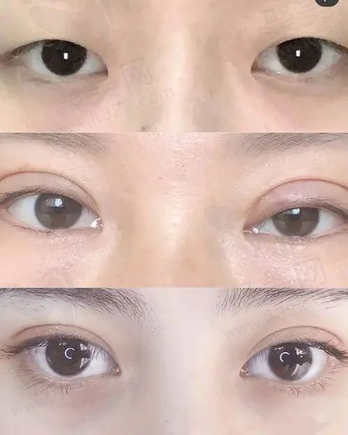 给各位姐妹们分享我在西安画美找李小正做的双眼皮，妈生眼我好爱！