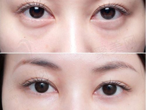 眼袋要怎样去掉才能不再有？去掉眼袋不做手术要多少钱呀？