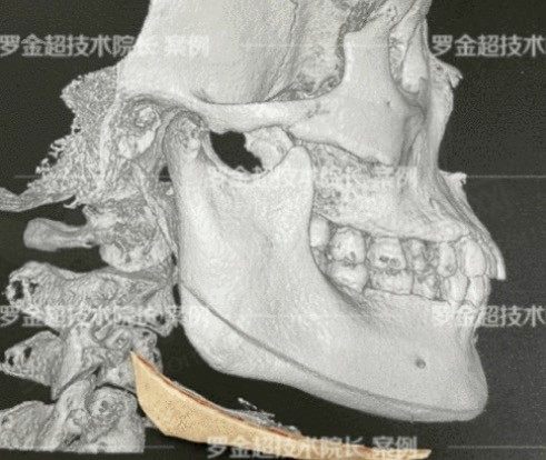 罗金超做下颌角技术怎么样好吗?还想知道罗金超颧骨内推做得怎么样?