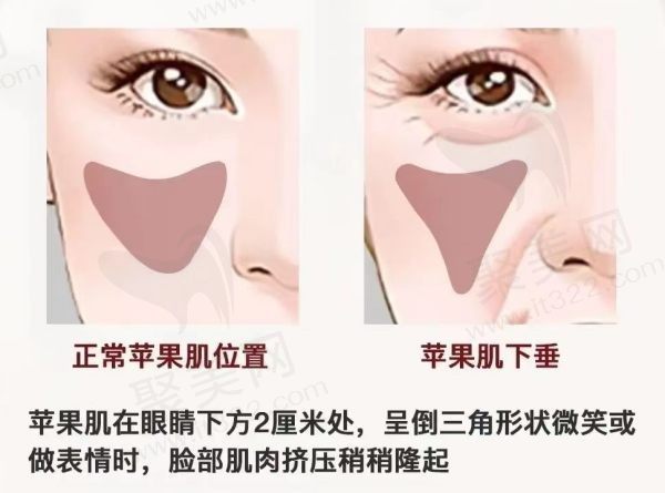 苹果肌下垂提升的较好方法？注射玻尿酸、埋线、手术提拉都可以