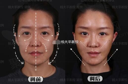 功课北京做面部提升有名的专家有：杨大平\黄寅守\穆宝安\李晓东\柳民熙等