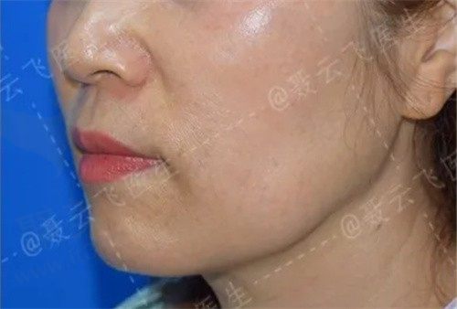 中下面部拉皮是大拉皮还是小拉皮?中下面部拉皮手术效果是否持久