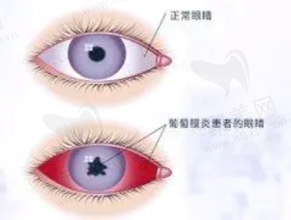 眼部葡萄膜炎有什么症状？想知道葡萄膜炎能治好吗？