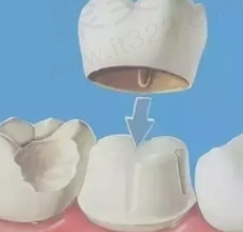 根管治疗和补牙有什么区别？根管治疗和补牙可以走医保吗？