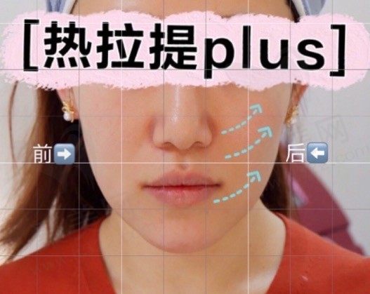 热拉提多久做一次,一疗程几次？还有热拉提价格一般多少钱一次？