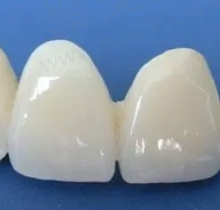 德派烤瓷和欧蓝德烤瓷牙有什么区别？哪个好？两者价格一样吗？
