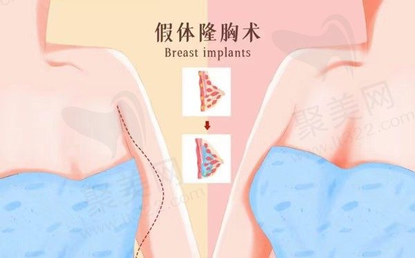 佛山顺德亚美美容隆胸技术不错，假体隆胸价格23800元起外形饱满