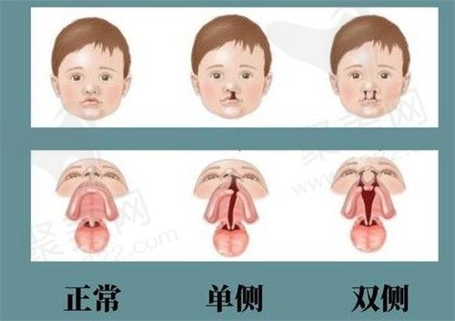 重庆松山医院唇裂修复王涛医生就不错,二期唇裂2w起经验多