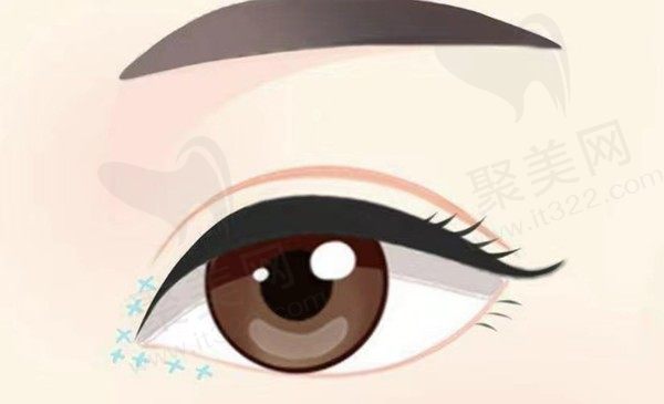 什么年龄割双眼皮比较好？平扇和开扇双眼皮哪个好看？